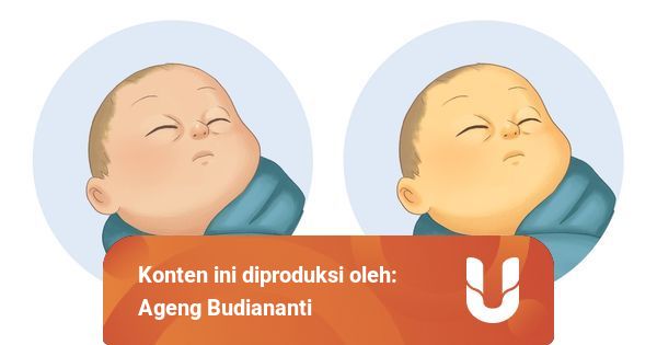 Penyakit Kuning pada Bayi; Cukupkah dengan Sinar Matahari